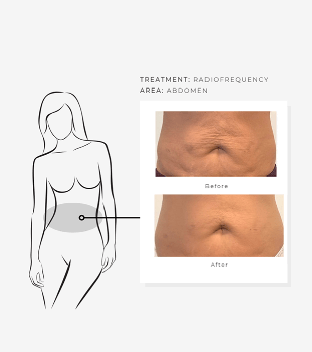 ZoShape Body Contouring