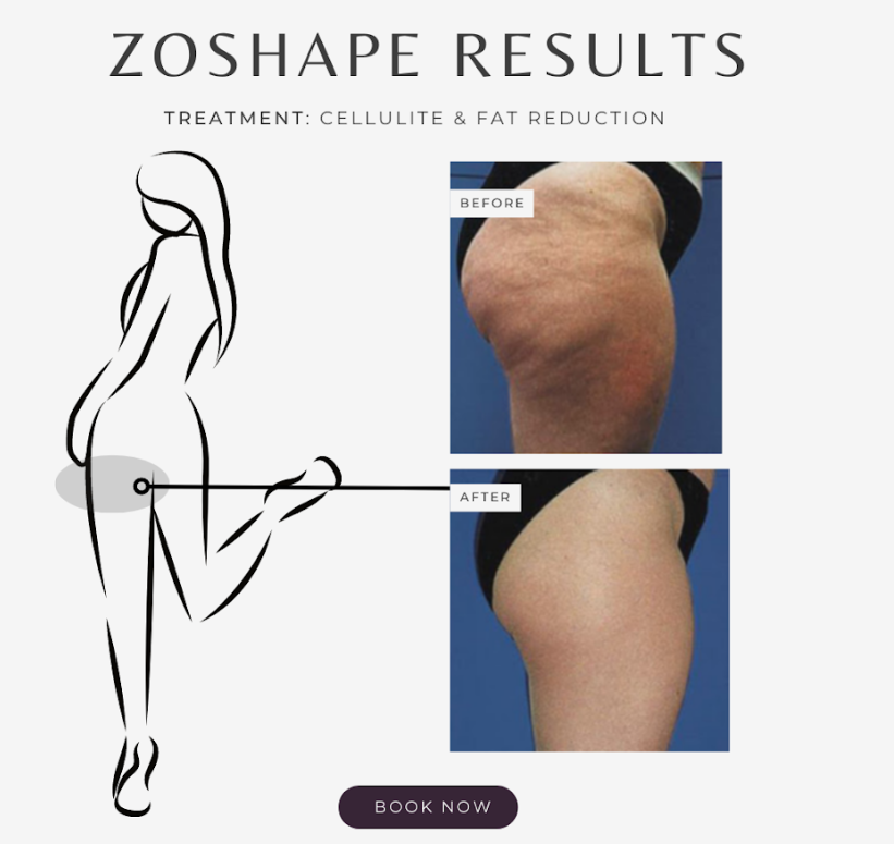 Non Invasive Cosmetic Treatments to Smooth and Shapen Your Body